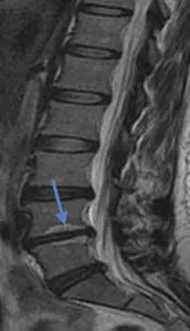 MRI image of the lower spine with a blue arrow pointing at one vertebra