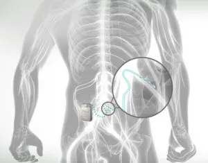Illustration of a lower back with an implanted device connected by a thin lead to the spine, shown enlarged in a circle
