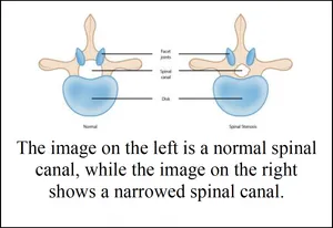 Two vertebrae seen from above, labelled Normal and Spinal Stenosis, with the facet joints, spinal canal and disk marked. Text: The image on the left is a normal spinal canal, while the image on the right shows a narrowed spinal canal.