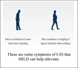 Two standing figures, labelled Pain or numbness in lower back when standing, and Pain, numbness or tingling in legs or buttocks when walking. Text: These are some symptoms of LSS that MILD can help alleviate.