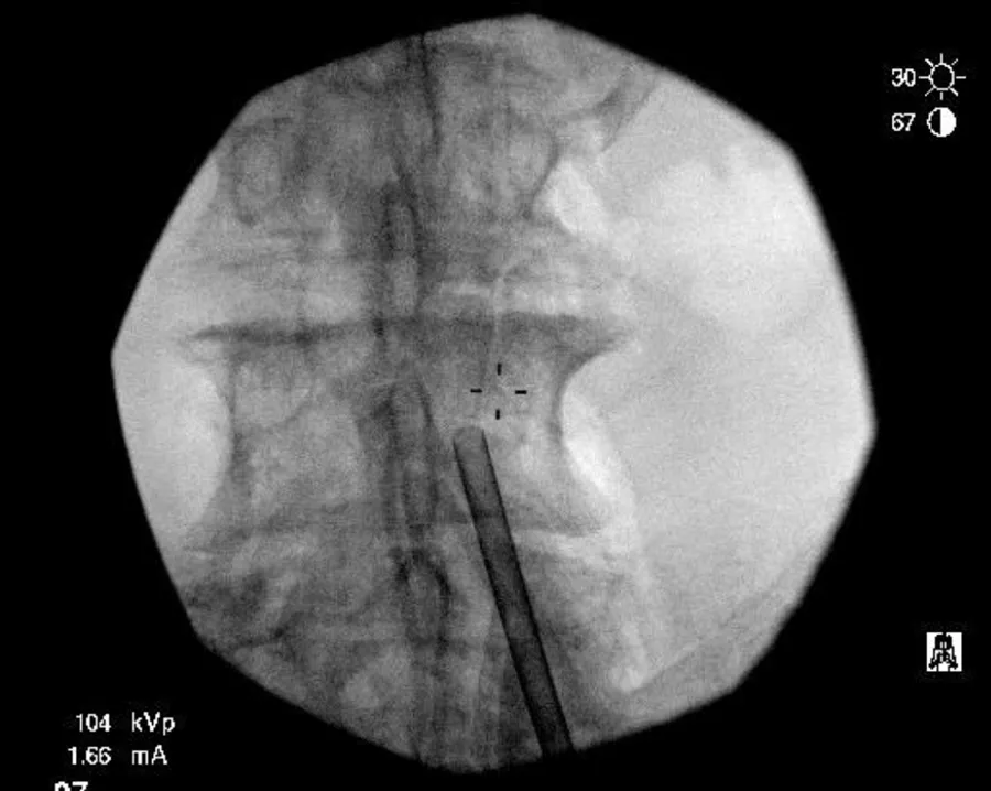 X-ray image of the spine with a portal instrument in place
