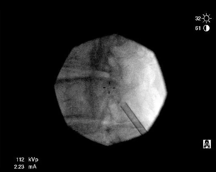 Closer X-ray image of the spine with a portal instrument in place