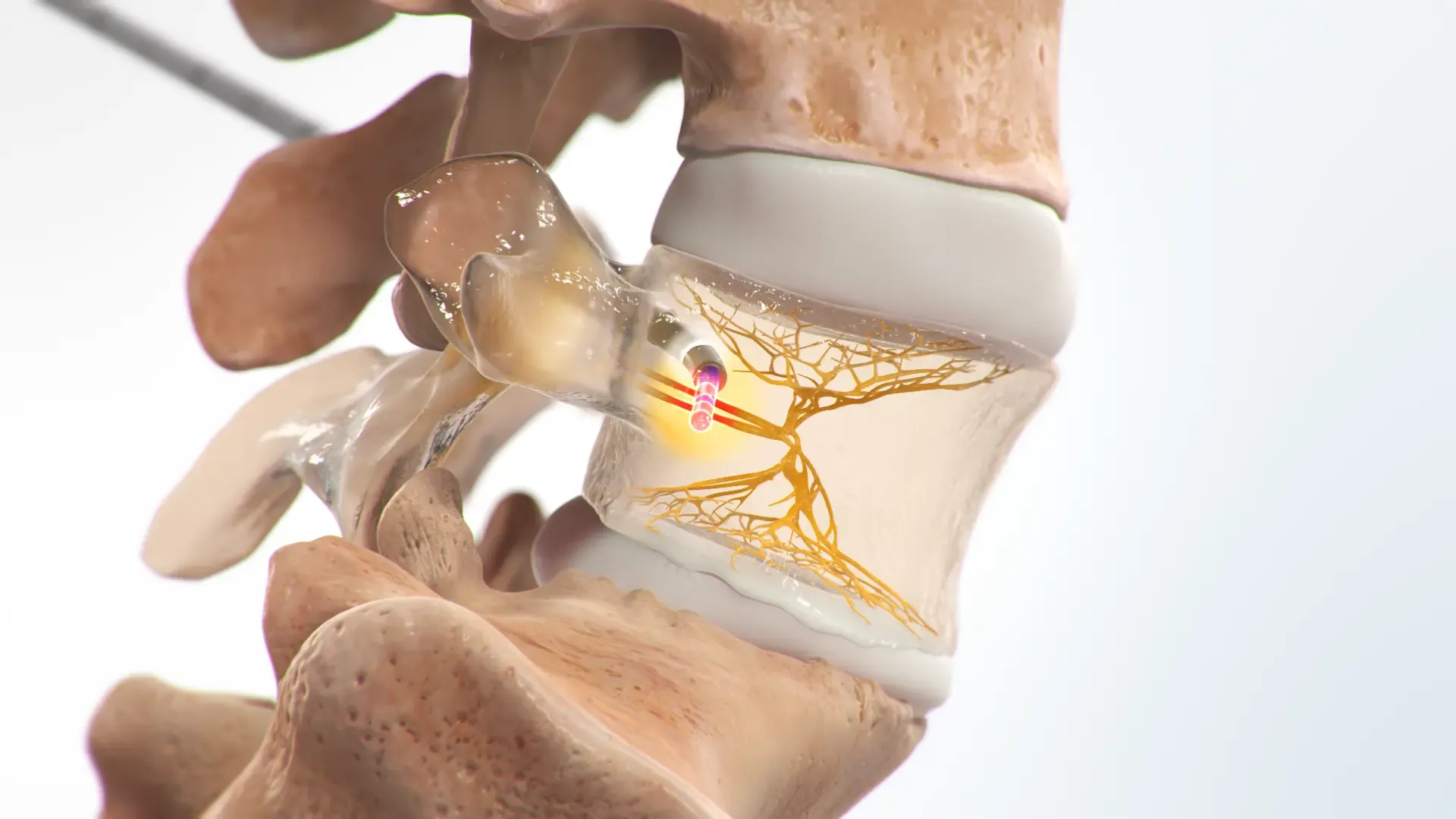Illustration of a vertebra with branching nerves inside it and a thin probe glowing at its tip within the bone