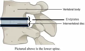 Side view of two vertebrae, labelled Vertebral body, Endplates and Intervertebral disc. Text: Pictured above is the lower spine.