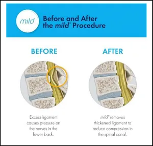 Before and After the mild Procedure. Before: excess ligament causes pressure on the nerves in the lower back. After: mild removes thickened ligament to reduce compression in the spinal canal.