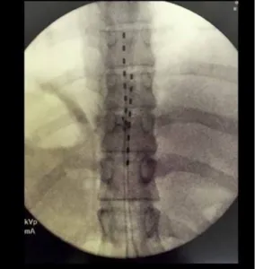 X-ray image of the spine with a lead running along it