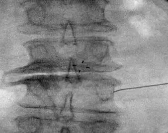 X-ray image of the spine with a needle in place
