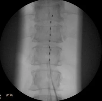 X-ray image of the spine with a lead running along it