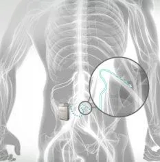 Illustration of a lower back with an implanted device connected by a thin lead to the spine, shown enlarged in a circle