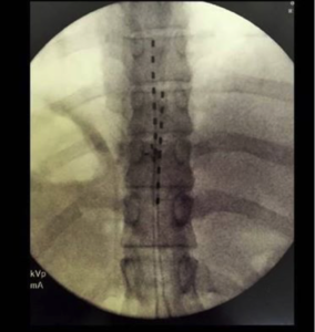 HF-10 Spinal Cord Stimulation for Pain